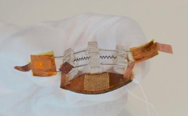 A sensor to improve performance of underactive bladders