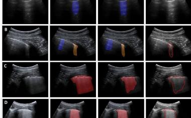 AI enables rapid ultrasound COVID-19 testing