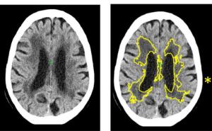AI improves stroke and dementia diagnosis in brain scans