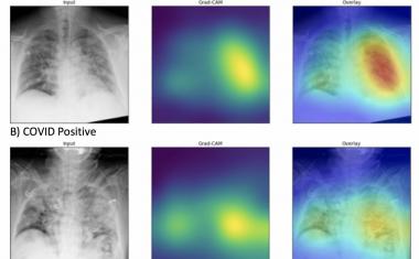 AI accurately detects COVID-19 on chest x-rays