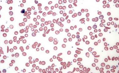CRISPR to cure sickle cell disease