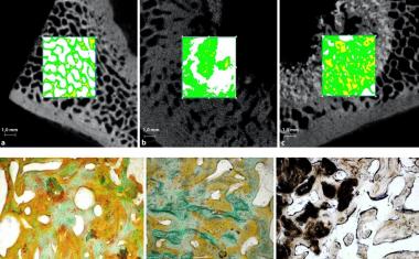 3D biocomposites can repair large bone defects