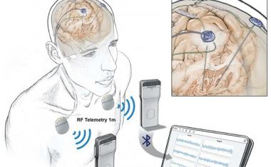 Parkinsons: Brain activities wirelessly recorded