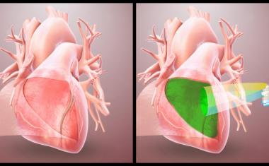 Hydrogel protects heart from post-op adhesions