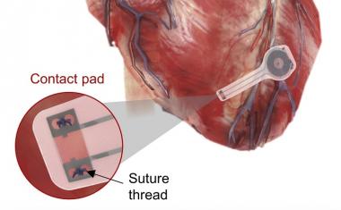 Transient pacemaker dissolves in body