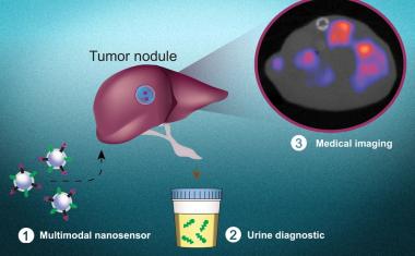 Noninvasive test detects cancer cells