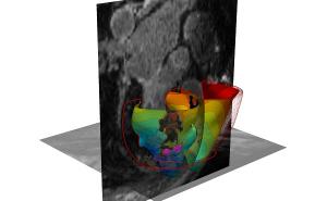 3D virtual simulations of irregular heartbeats