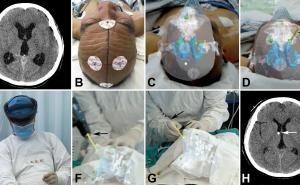 Holographic images increase neurosurgeons performance