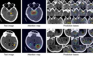 AI system learns to diagnose intracranial hemorrhage