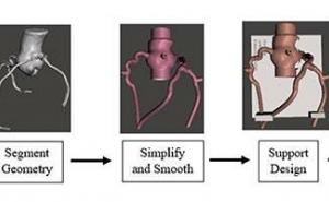3D models used in assessing coronary artery disease