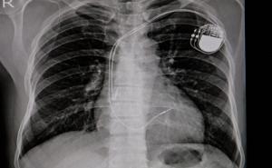 In emergencies: AI can improve X-ray identification of pacemakers