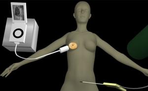 Cancer cryoablation probe could help breast cancer patients
