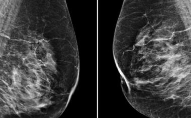Google-powered AI spots breast cancer