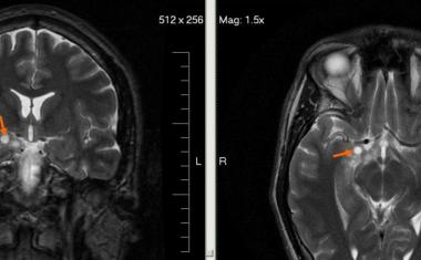 AI & MRI look into the genome of brain tumors