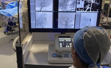 Surgeons successfully treat brain aneurysms using a robot