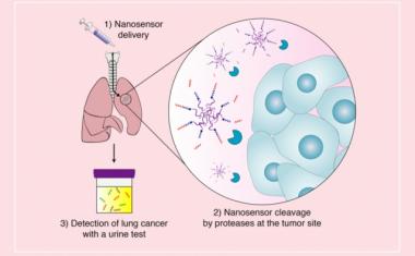 Sensors could offer early detection of lung tumors