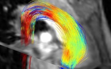 AI accelerates blood flow MRI