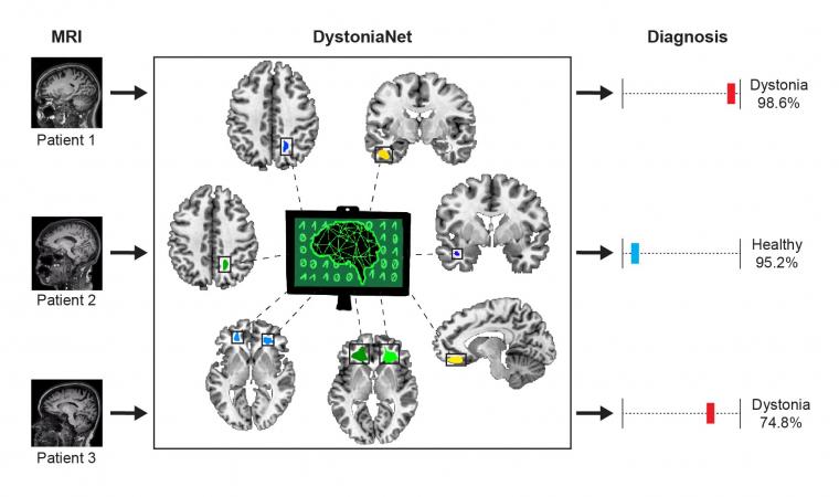 A diagram of a the DystoniaNet platforms process in diagnosing dystonia from...