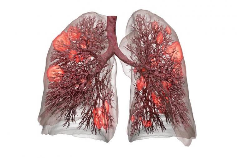 Utilizing the data of a CT lung scan, the software uses artificial intelligence...