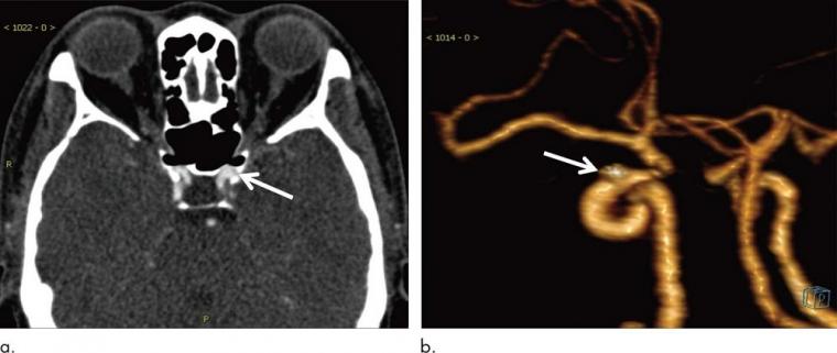 A 54-year-old woman with aneurysm 2.9 mm in maximum diameter located on left...