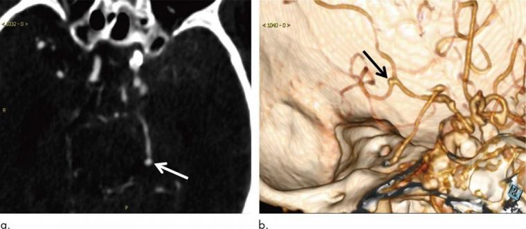 A 93-year-old woman with aneurysm 2 mm in maximum diameter located on left...