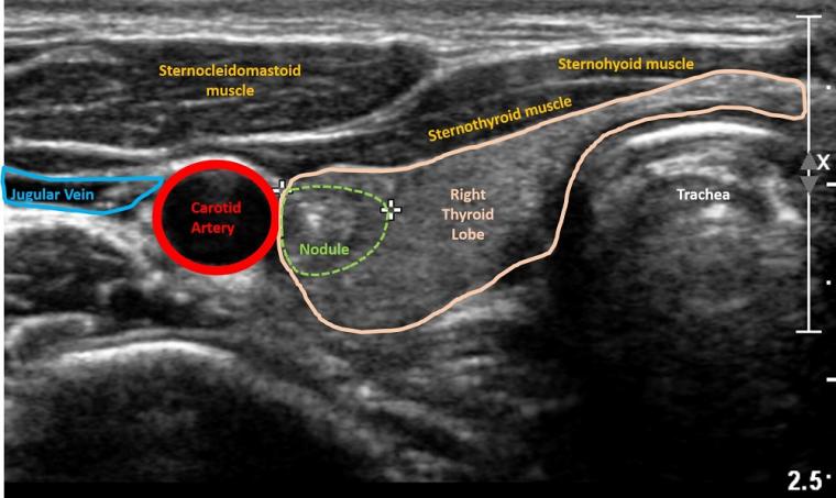 Ultrasound image of thyroid nodule.