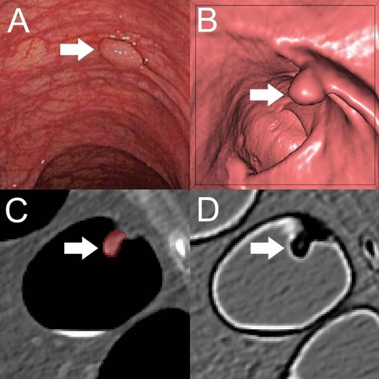 A, Optical colonoscopy and, B–D, CT colonography of a 9-mm polyp (arrow) in...