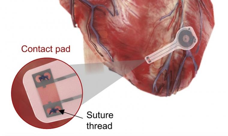 Illustration of the device mounted on a heart.
