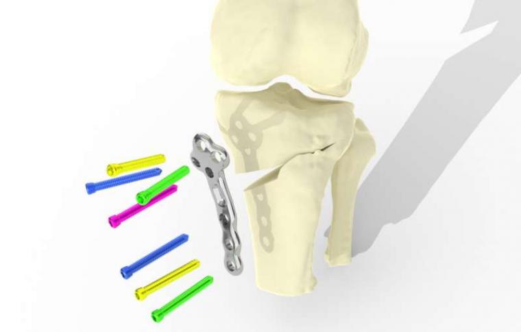 The implant preserves the existing joint and can be used at an earlier stage of...