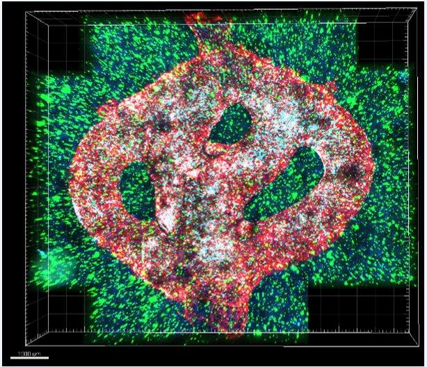 Microscopic image of the 3D-bioprinted glioblastoma model. The bioprinted blood...