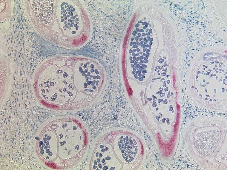 Histological section of Onchocerca volvulus, the cause of river blindness,...