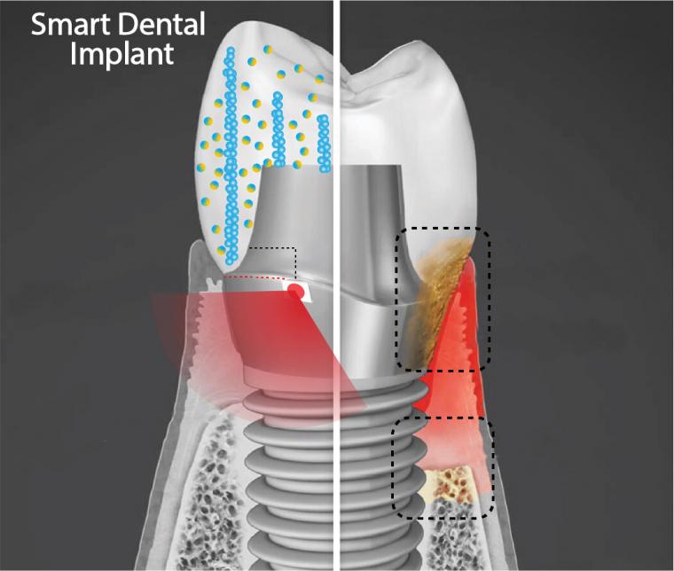Illustration of “smart” dental implant