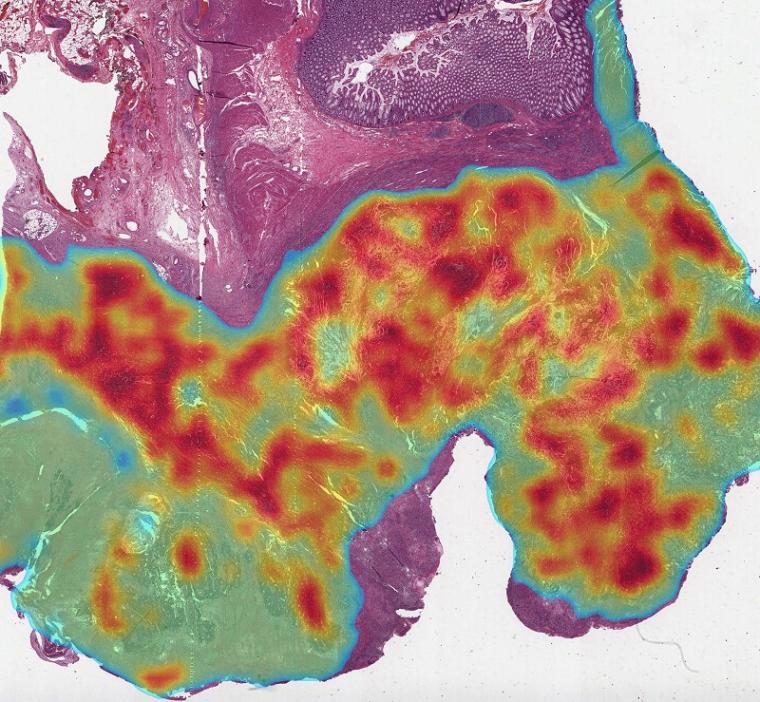 Spatial map of a colorectal cancer tissue section produced by the IDARS...
