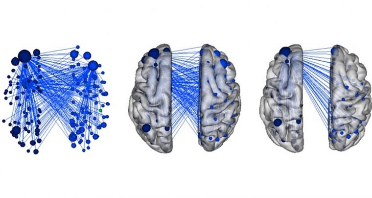 The study revealed brain hubs (dots) and connections (lines) predictive of...