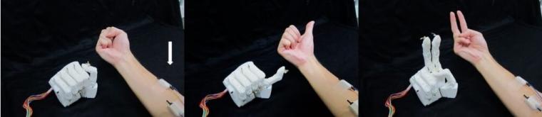 The prosthetic hand and socket. The hand is controlled by the Cybernetic...
