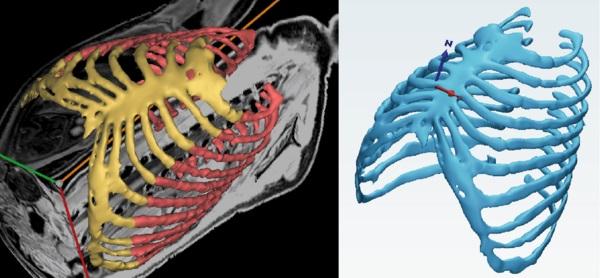 Segmentation of the MRI image of the rib cage (red) and cartilage structure...