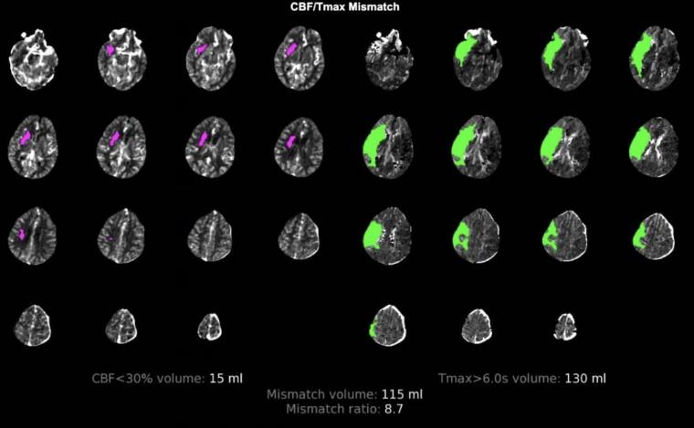 AI processes images from a CT scan of the head to find parts of the brain that...