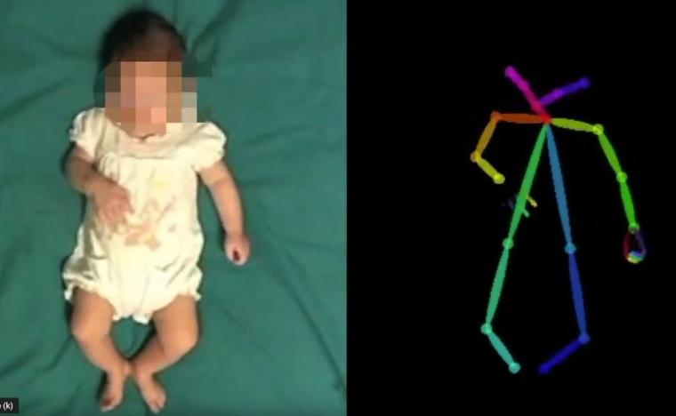 A video recording of an infant lying in bed can be analyzed with artificial...