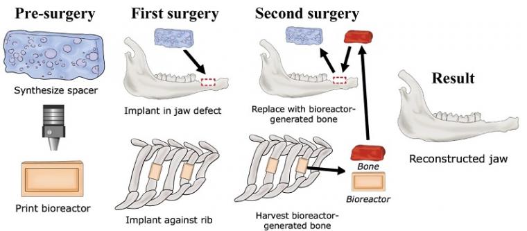 Researchers have developed a technique to grow custom-fit bone implants to...