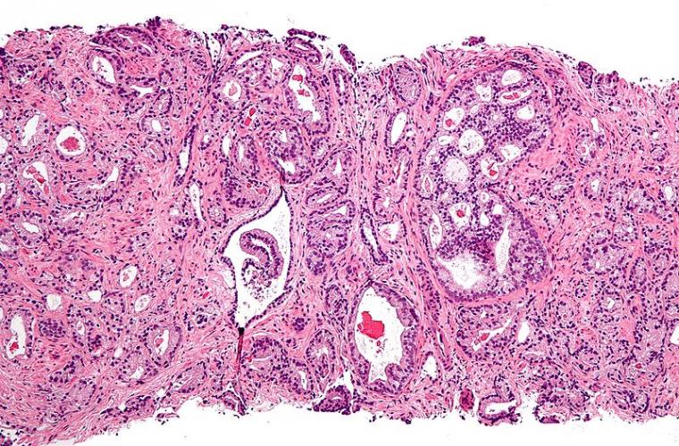 Micrograph showing prostatic acinar adenocarcinoma - the most common form of...