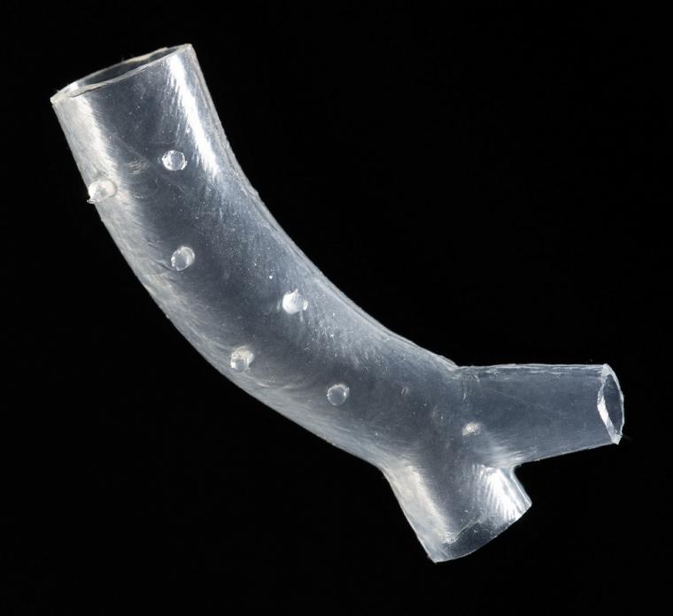 An example of a patient-specific airway stent developed at Cleveland Clinic.