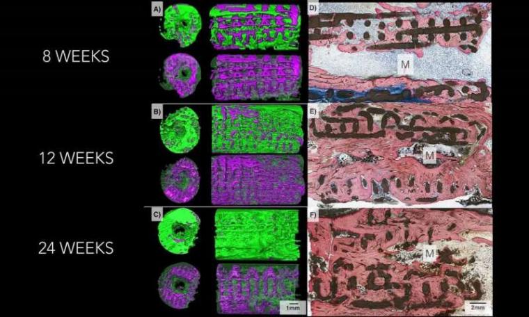 Three-dimensional imaging on the left shows how bone, in green, replaced the...