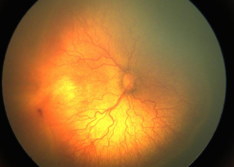 A fundus image shows an eye with aggressive posterior retinopathy of...