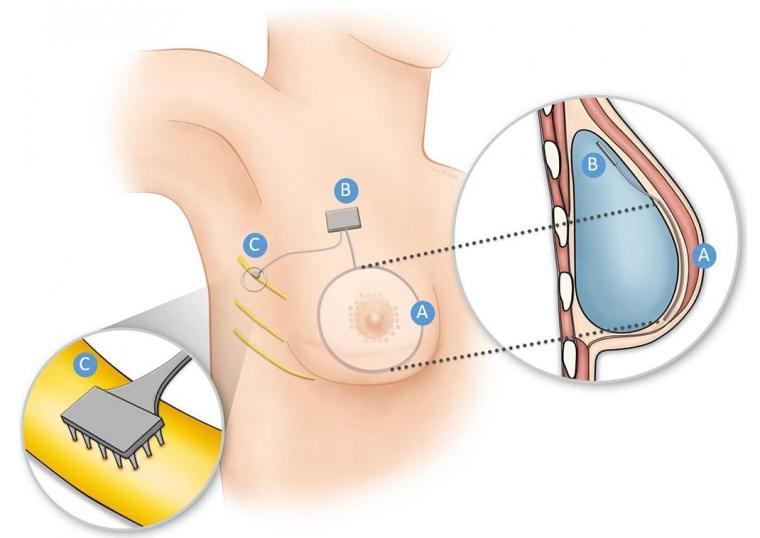 Schematic illustration of the concept for a breast reconstructed using an...