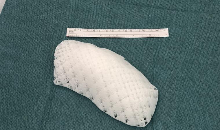 Patient-specific 3D printed chest implant.