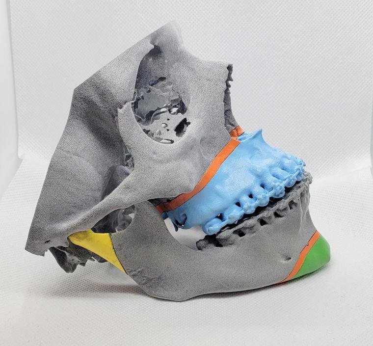 In orthognathic surgery the printed model simulates cutting and the new...